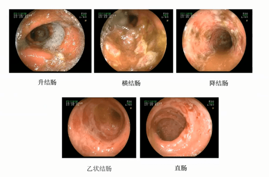 遇到肠道溃疡只知道炎症性肠病这些鉴别诊断不能漏