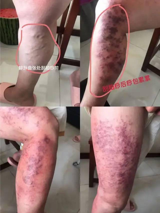 只要不影响吃喝,就不会选择治疗,第一次刮痧后就出了很多黑紫色痧