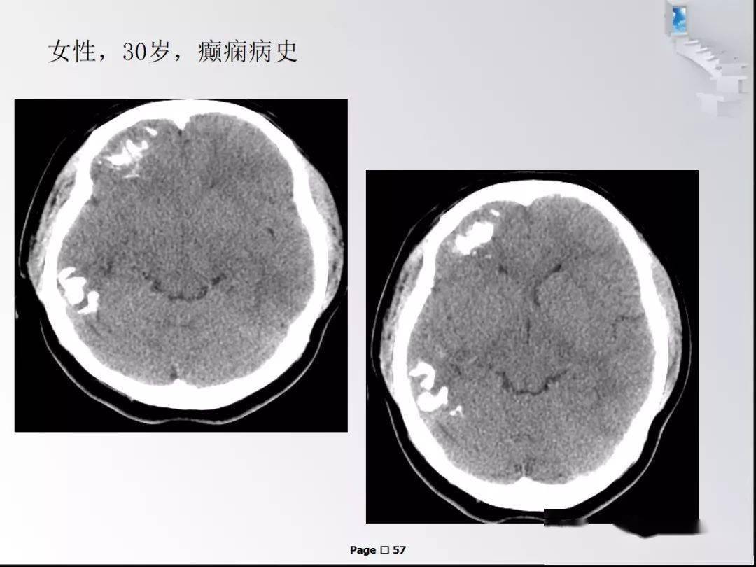 颅内钙化性病变_肿瘤