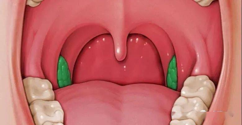 扁桃体位于口咽两侧腭舌弓和腭咽弓之间的三角形扁桃体窝内,左右各一