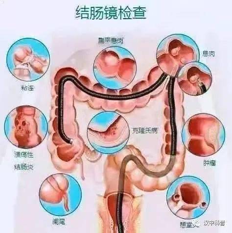 【专家讲科普】镇巴县人民医院吴明兴:肠镜检查及流程