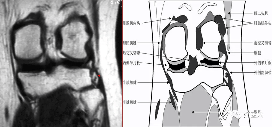 在冠状面的后部,内侧副韧带内层与内侧半月板之间相隔略低信号的滑膜