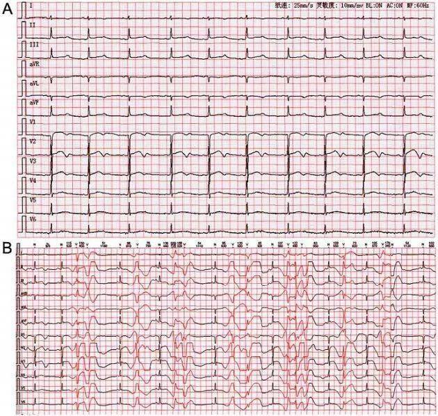 原发性长qt间期综合征的心电图与动态心电图