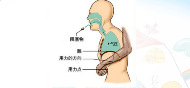 【医护手记】孩子气管异物梗阻,该怎么办?