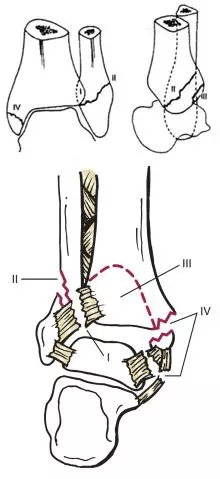 踝关节骨折的lauge-hansen分型