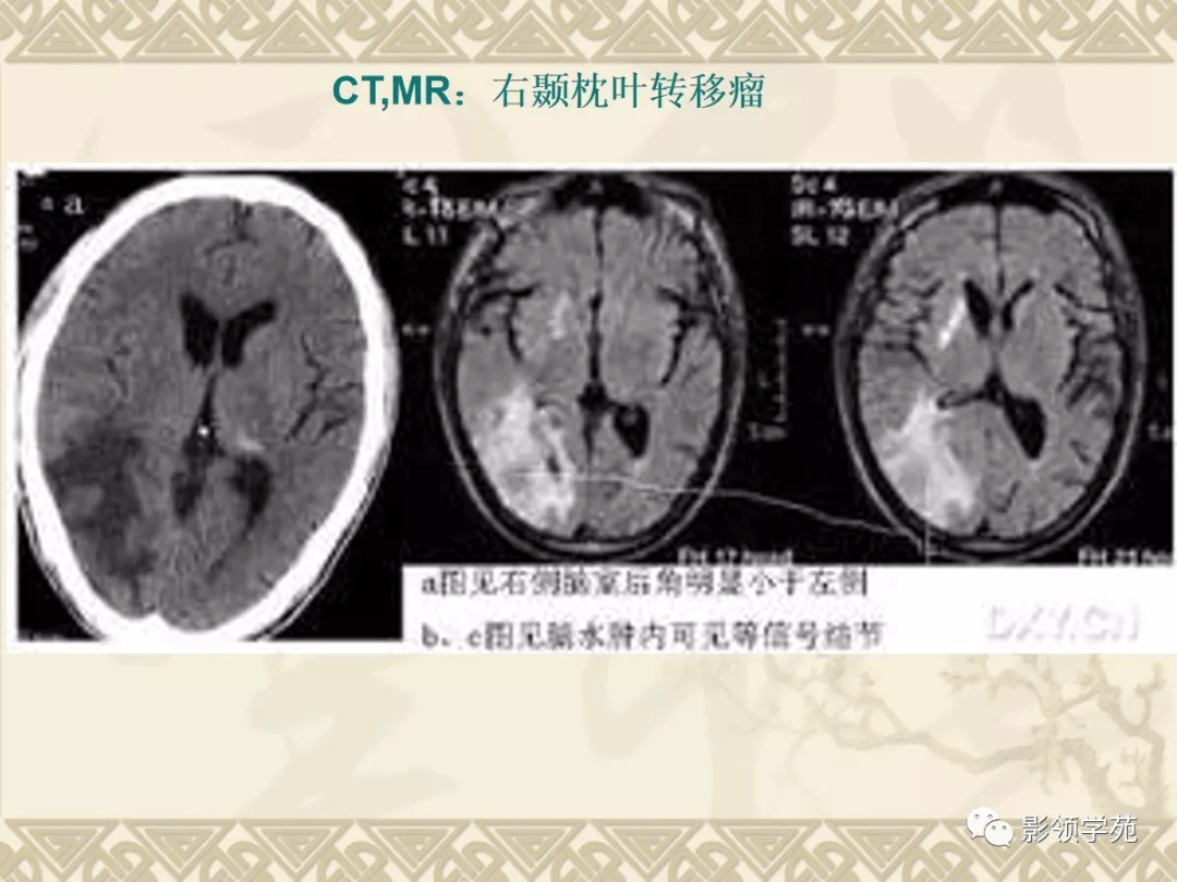 常见脑肿瘤的影像诊断