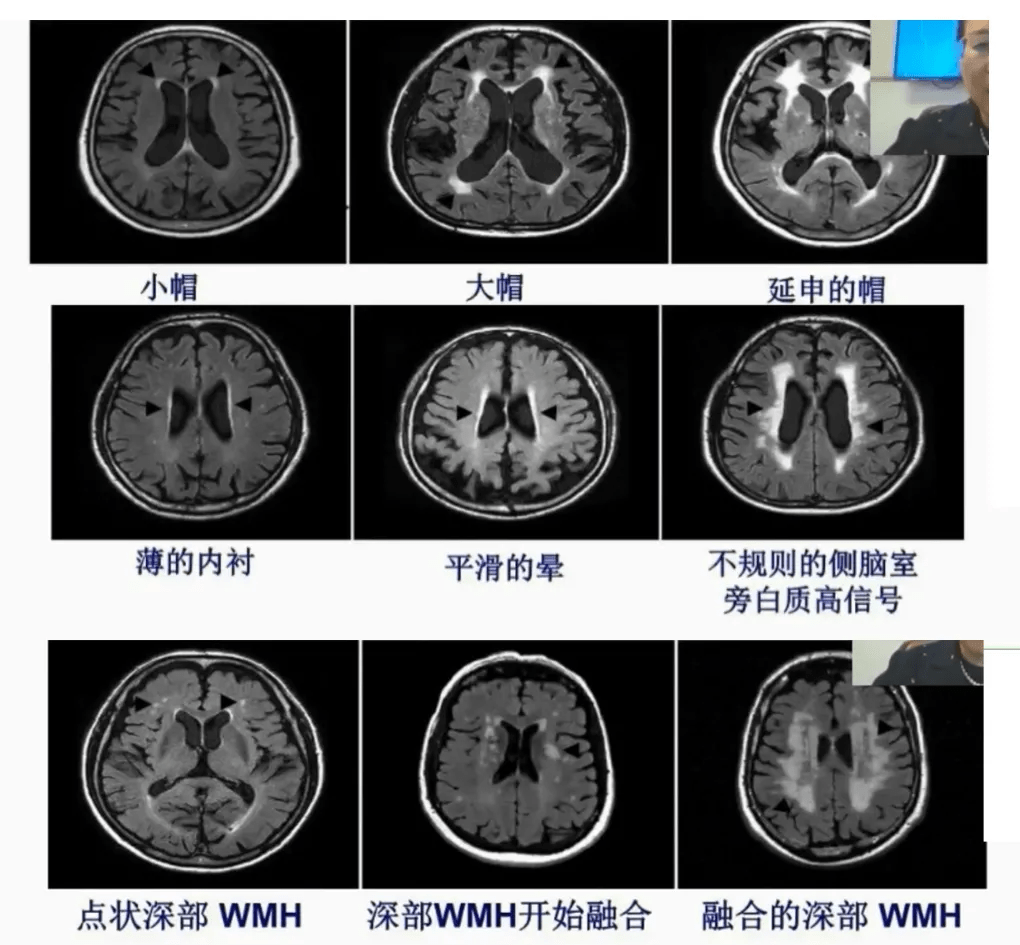 脑小血管病的诊断和治疗!讲的很完整