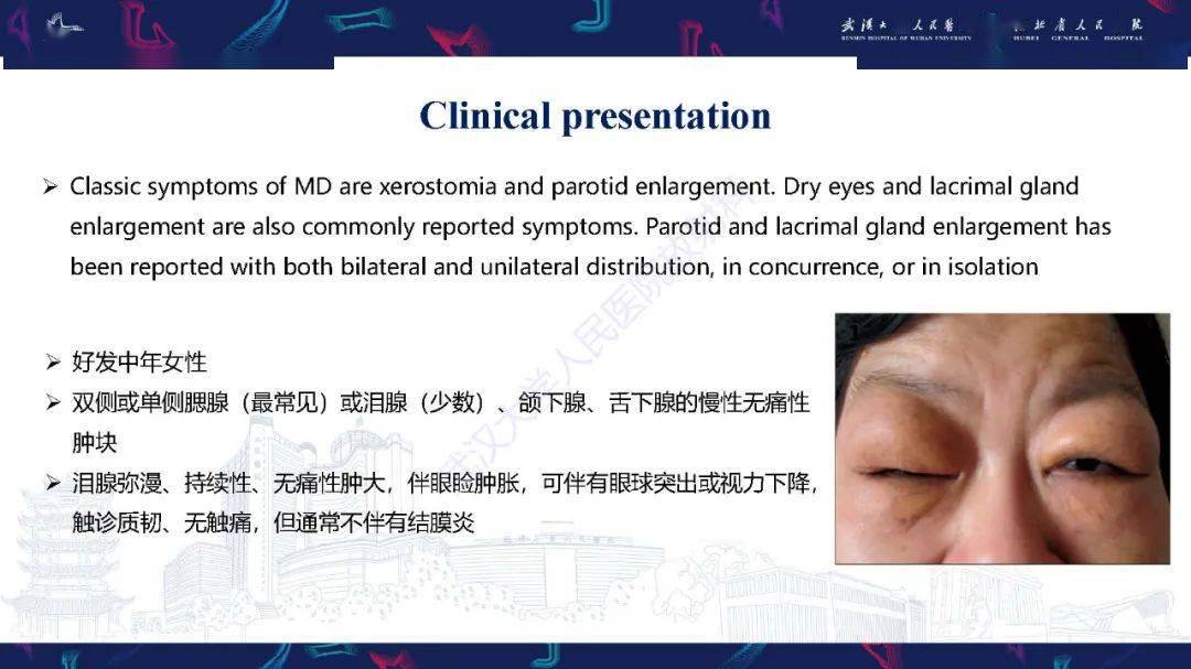 泪腺良性淋巴上皮病变mikulicz病影像诊断