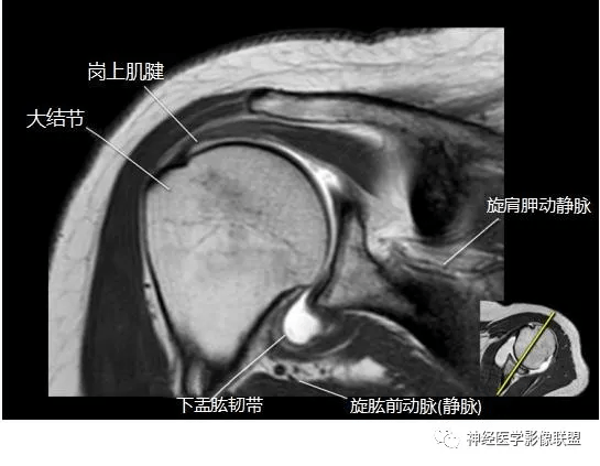 肩关节磁共振断层解剖