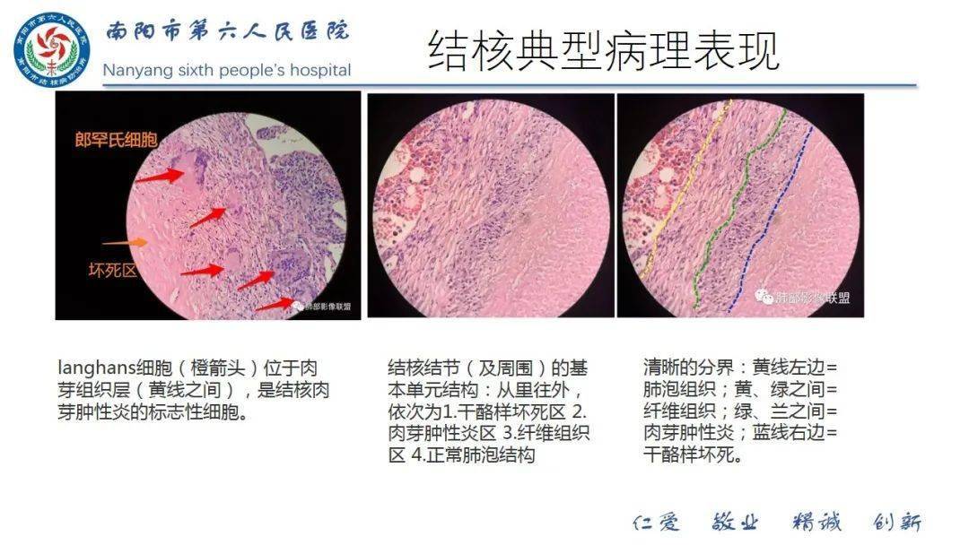 粟粒型肺结核典型表现影像学:不典型表现(肺结核和covid19)结核病人的