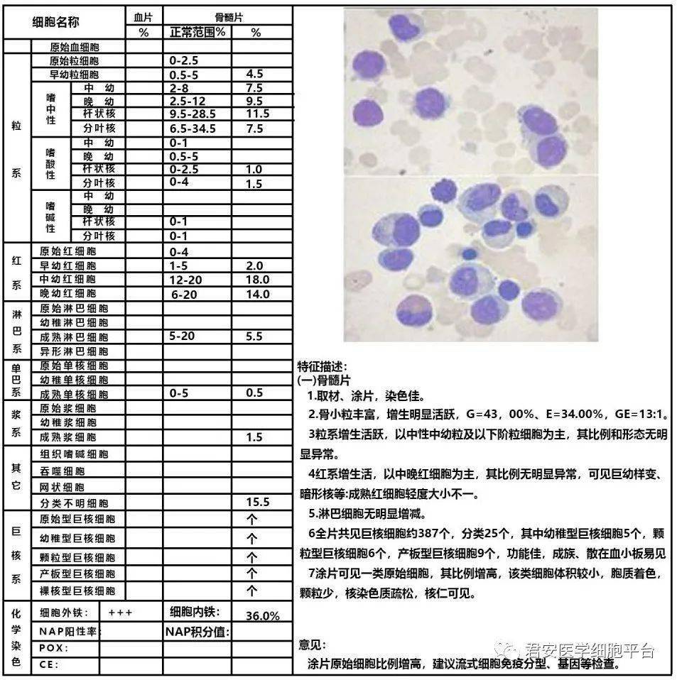 b 细胞淋巴瘤骨髓侵犯