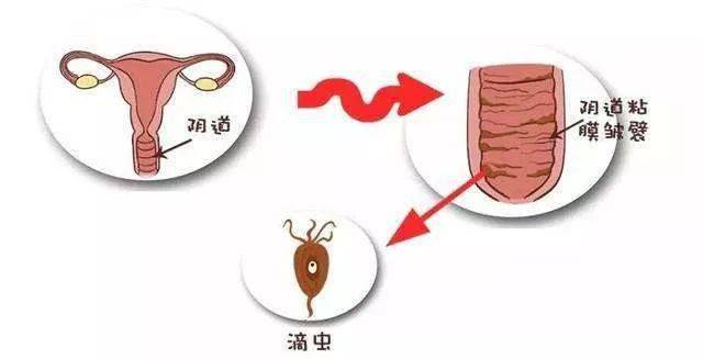 患滴虫性阴道炎前有这3个暗示