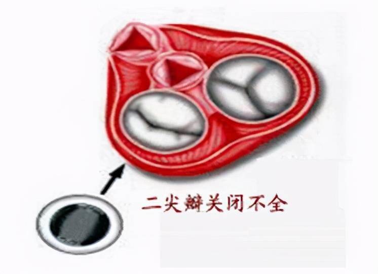 心脏二尖瓣三尖瓣问题都需要吃药或手术辟谣找原因再确定