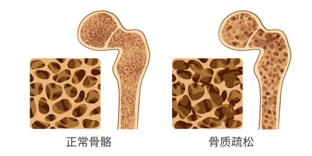 查骨密度可通过骨密度检查发现早期骨质疏松.