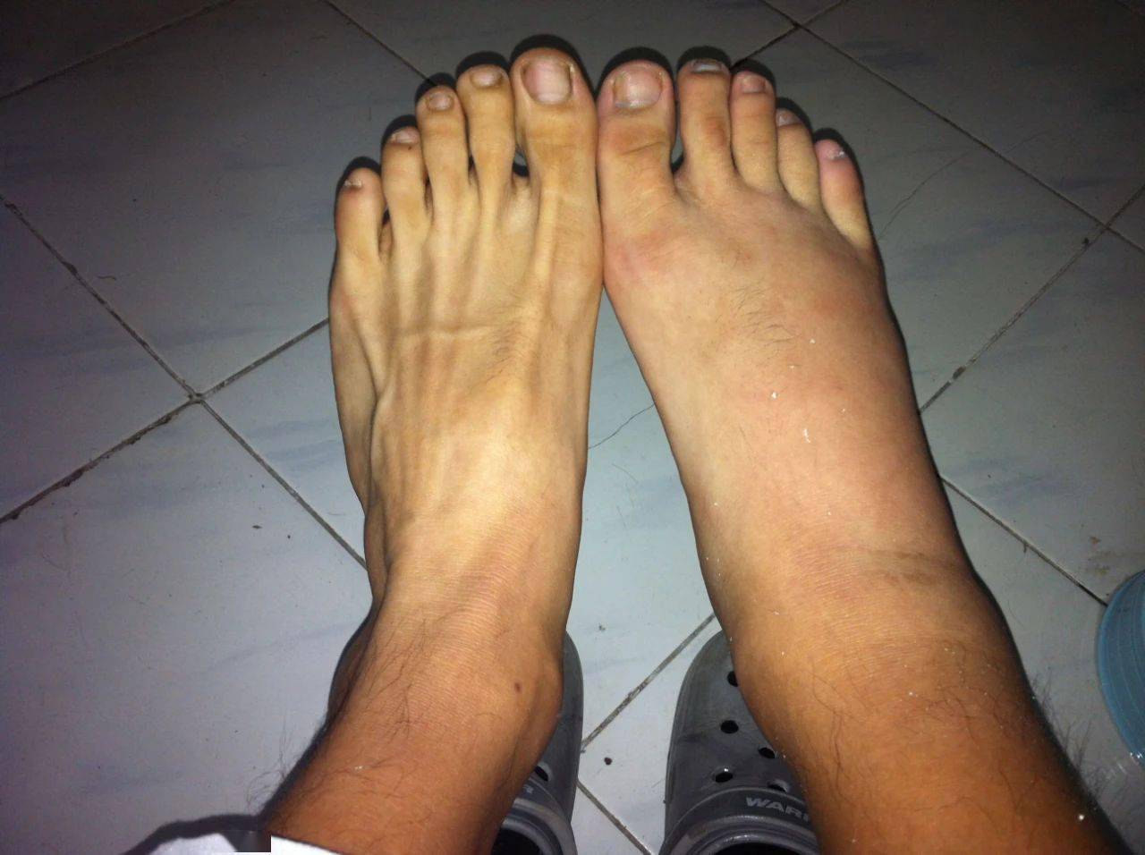 医生提示:若脚部出现这3大症状,或是血液粘稠的表现,需警惕