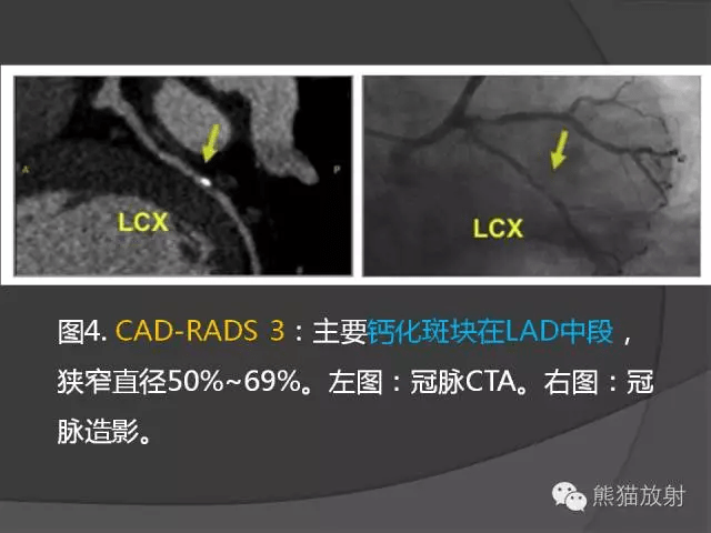 冠状动脉斑块评估管腔狭窄程度分级