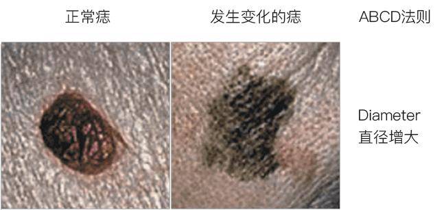 "c"是颜色(color,痣出现不同深浅或完全不同的颜色(比如黑色,咖啡