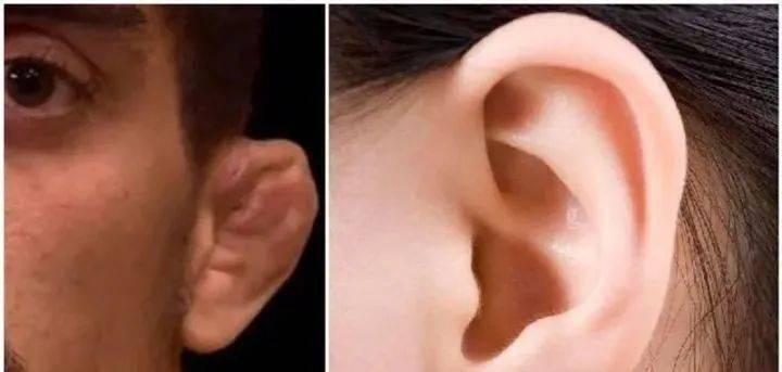 饺子耳vs正常耳朵