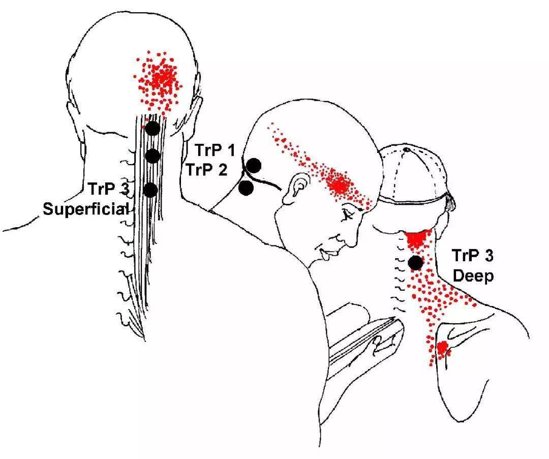 当颈半棘肌内的激痛点会在颅骨底部和颈部之间产生疼痛和酸痛.
