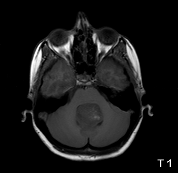髓母细胞瘤:肿块压迫第四脑室,伴上游急性阻塞性脑积水;肿块在t1w1 呈