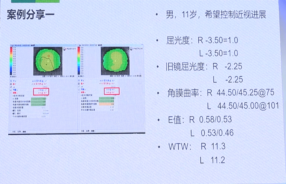 角膜地形图数据