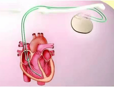 心脏起搏器植入