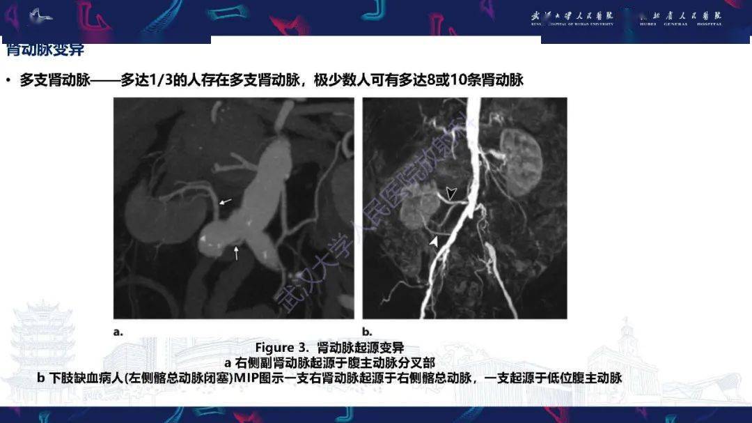 肾动脉解剖病理及血管内治疗