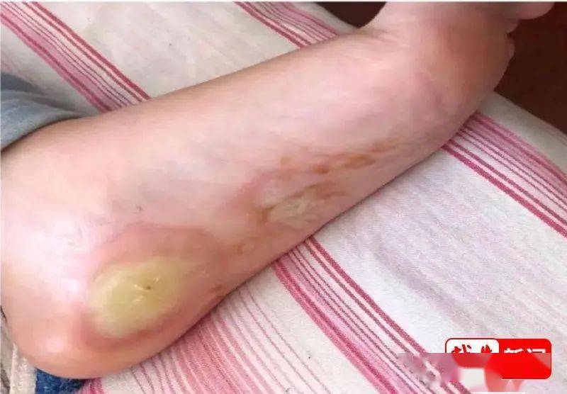 "神婆"燃香治病,绍兴8岁女童拼命挣扎!惨不忍睹