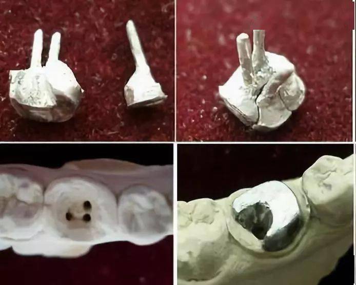 残冠,残根或者畸形牙治疗后该如何选择桩核材料?