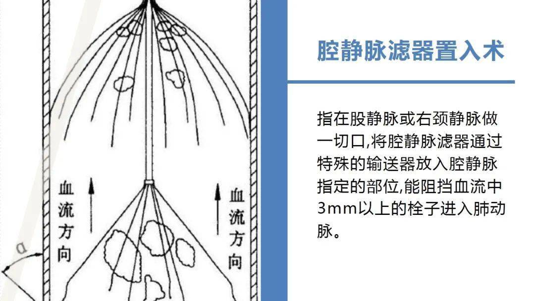 【ppt】下腔静脉滤器置入术围术期护理查房