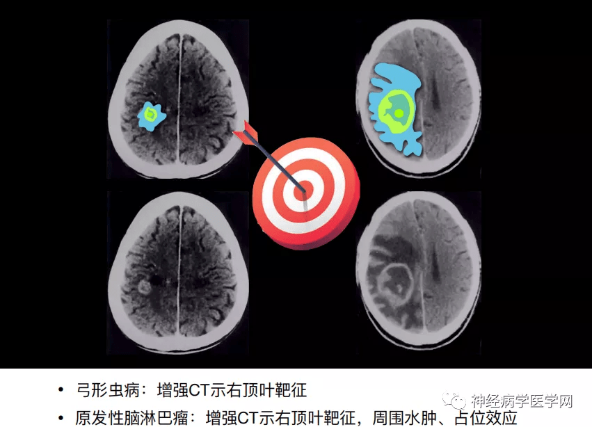 颅脑疾病ct影像特异征象--ct篇
