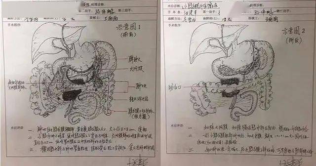 超赞手绘"手术图谱"!六旬老院长圈粉无数