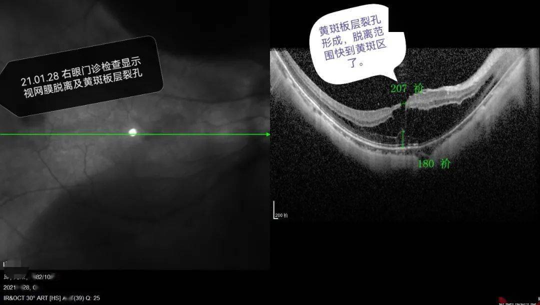 近视高达1300度!龙岩男老师眼前黑影遮挡,医生这么做后还他1.0视力.