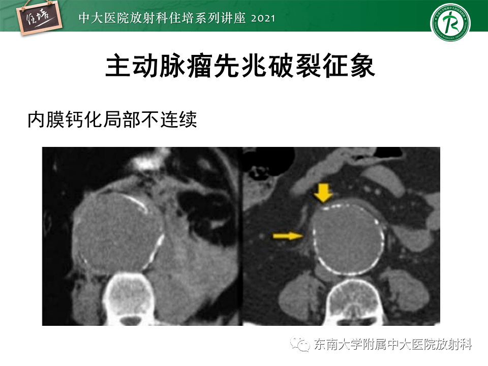 【中大放射住培系列讲座】急性主动脉综合征ct危险征象识别