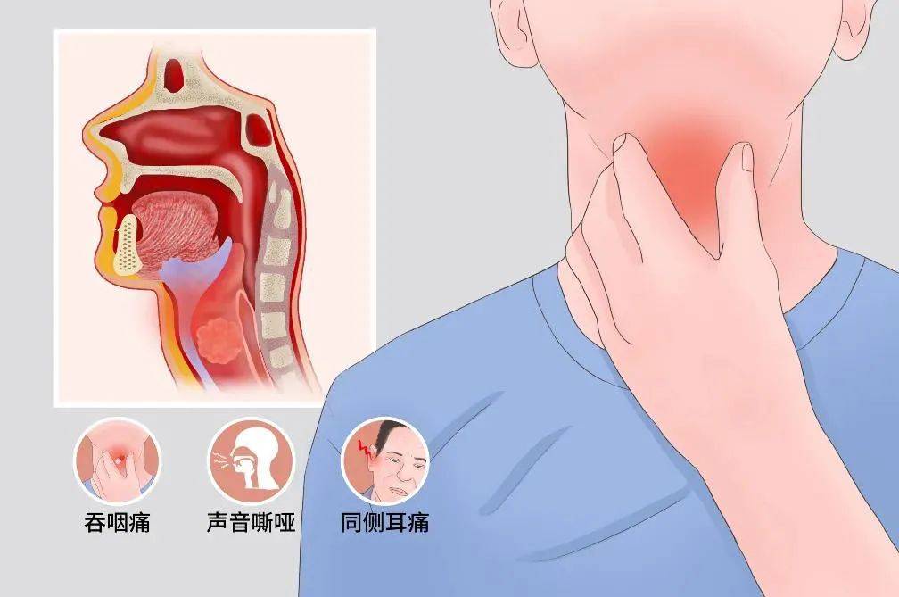 长期咽痛不见好转,警惕下咽癌