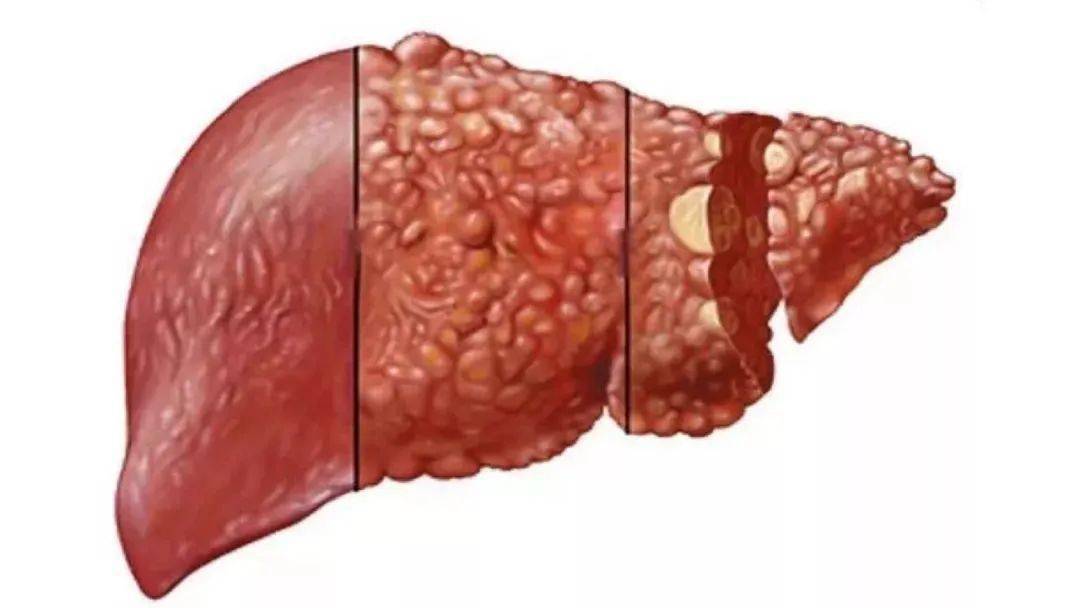 与急性肝脏相似,脂肪肝也是因为肝脏的肿大,导致肝包膜的感觉神经出现