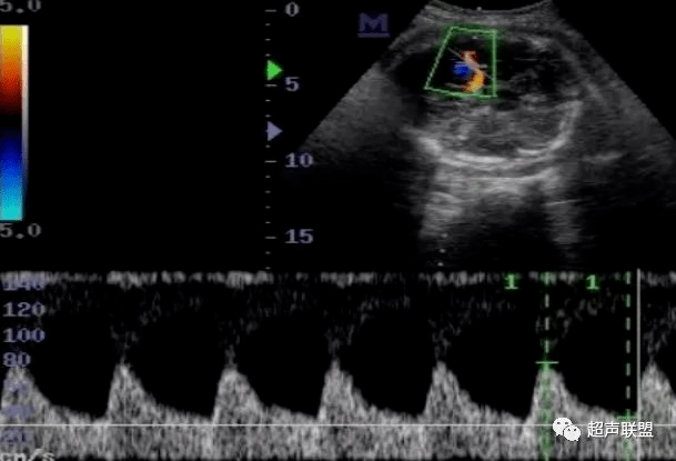 妇产科超声:多图讲解胎儿宫内窘迫缺氧的诊断