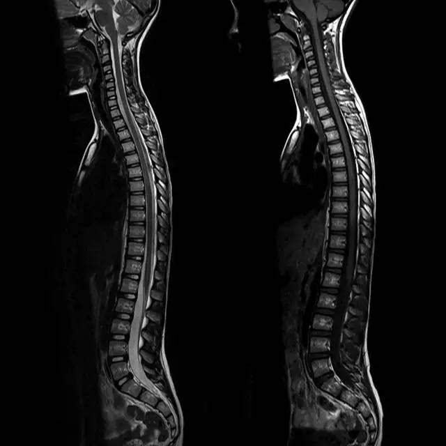 脊柱脊髓成像技术