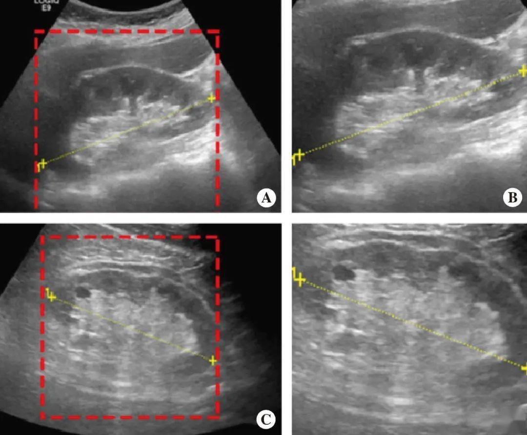 人工智能在肾脏病变超声诊断中的应用