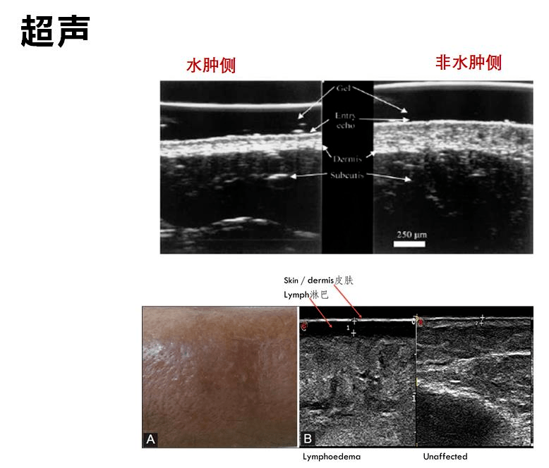 【乳腺癌与手功能】乳腺癌术后淋巴水肿的评估