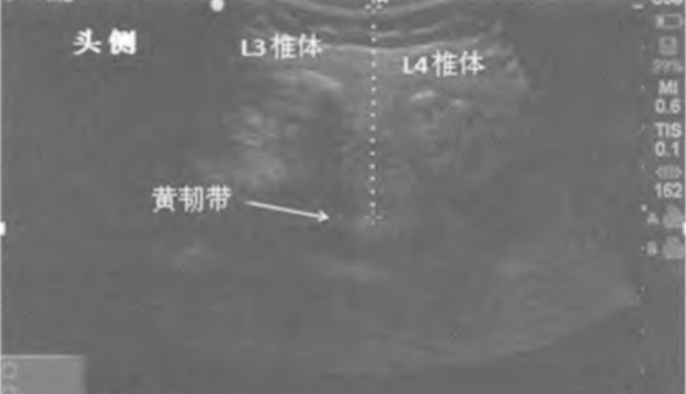 宝妈体重超标 二剖麻醉很烦恼