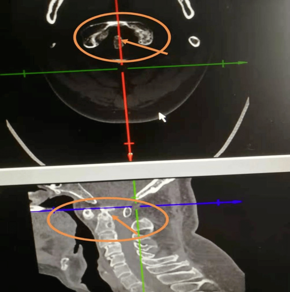 城医技术丨脊柱外科手术助寰枢椎脱位患者摆脱病痛