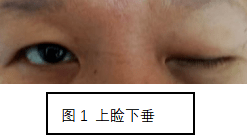 黄女士自述在一次外伤后出现左眼上睑下垂,眼外斜,转动受限,伴有复视