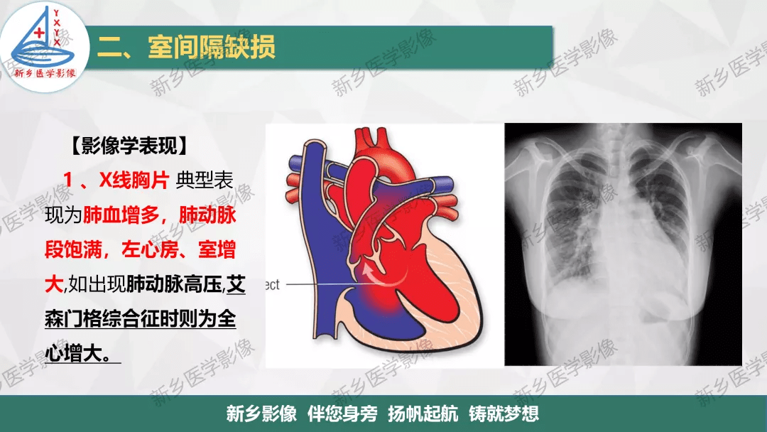 「一图明白」房缺,室缺,动脉导管未闭如何分型?