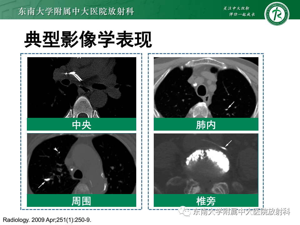 骨水泥肺栓塞影像表现