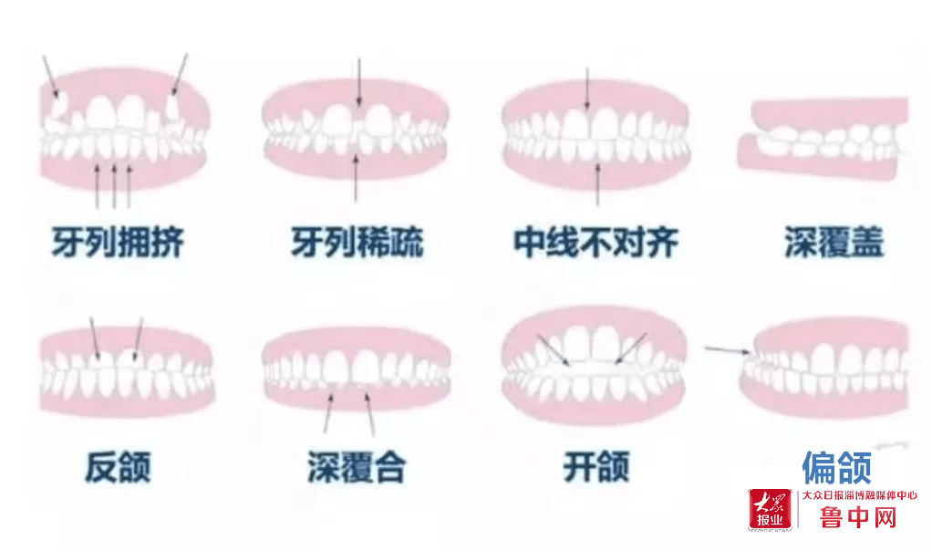 而影响了面部的正常发育,换完牙后,即使进行了牙齿的矫治,面型也常常