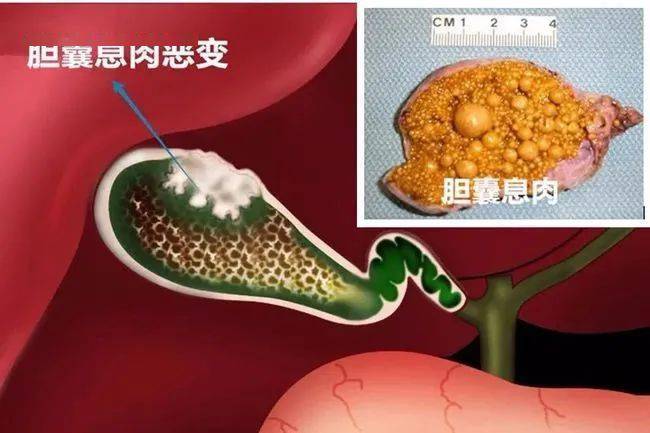 超声查出有胆囊息肉,一定要切除胆囊吗?