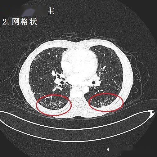 间质性肺炎的典型图谱,最全解析!