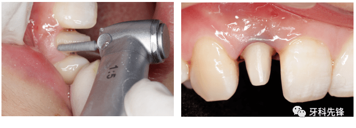 病例前牙单冠修复小改动大改观