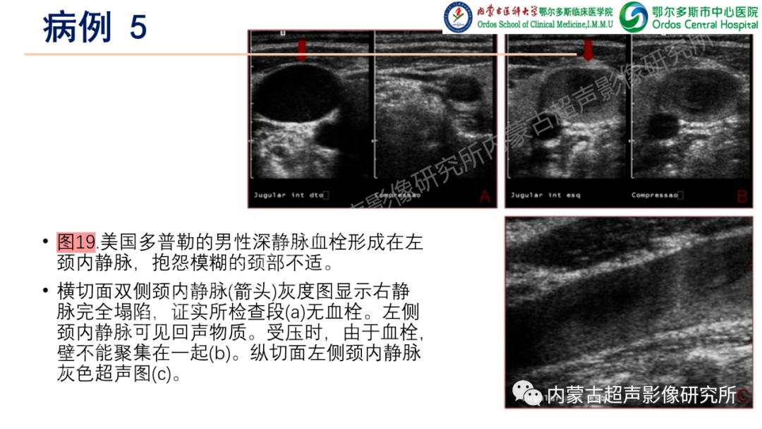 上肢深静脉血栓的超声检查.